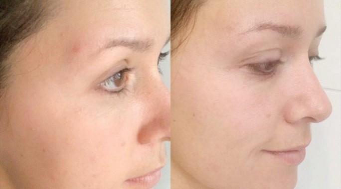 Akne – kako zdraviti akne na obrazu