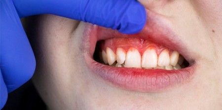 Zobne obloge so biofilm, ki ne povzroča le bolezni ust in zob
