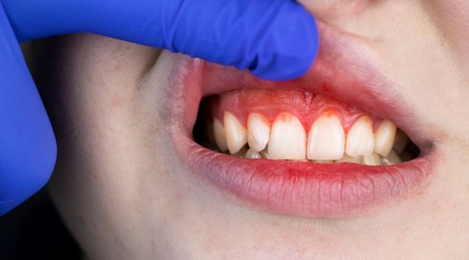 Zobne obloge so biofilm, ki ne povzroča le bolezni ust in zob