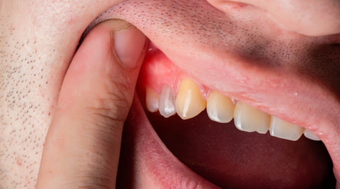Vnete dlesni | kaj pomaga oz. kaj je najboljša preventiva?