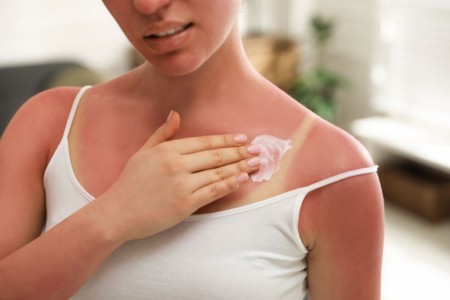 Sončne opekline: Kako se zaščititi in ozdraviti kožo?