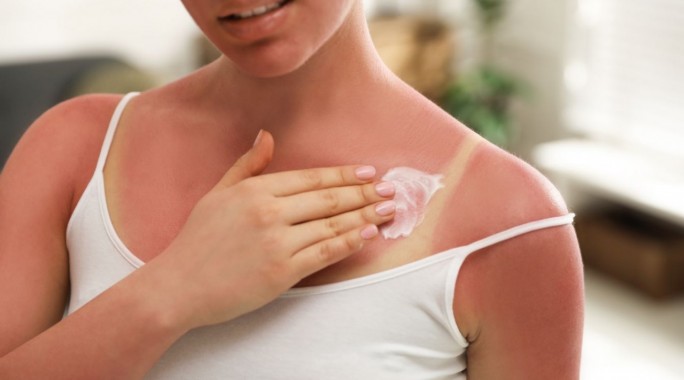Sončne opekline: Kako se zaščititi in kako ozdraviti opečeno kožo s Cicatridino?