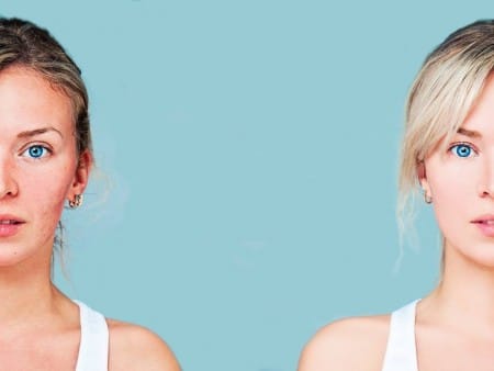 Ialuxid gel proti mozoljem na koži