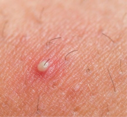 Folikulitis ali vnetje lasnega mešička po britju