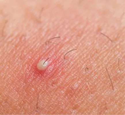 Folikulitis ali vnetje lasnega mešička po britju