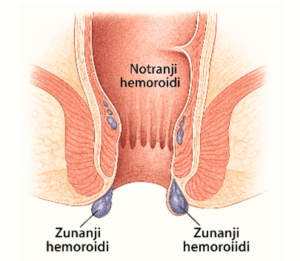 zunanji hemeroidi