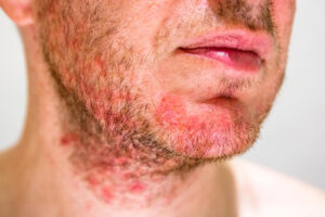 Folikulitis