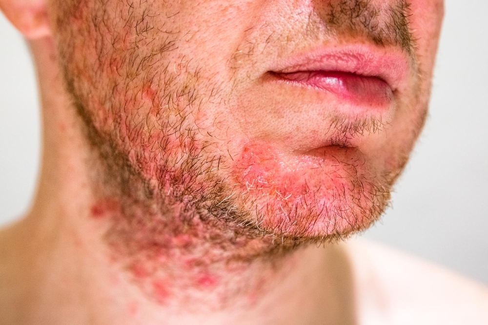 Folikulitis